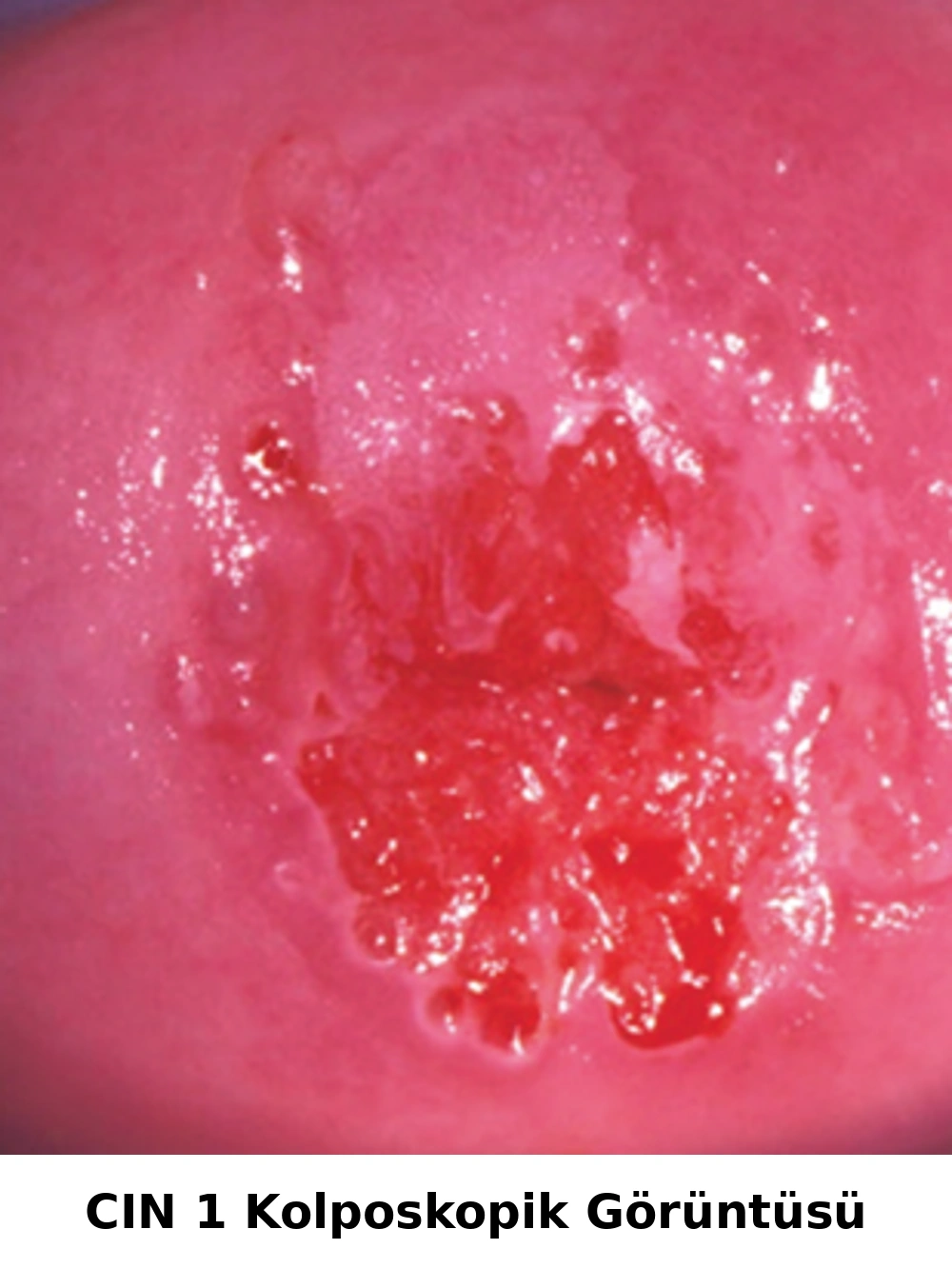 Düşük dereceli servikal intraepitelyal neoplaziye (CIN 1) ait kolposkopik görünüm. Hafif asetowhite epitel ve düzenli vasküler paternler izlenmektedir.