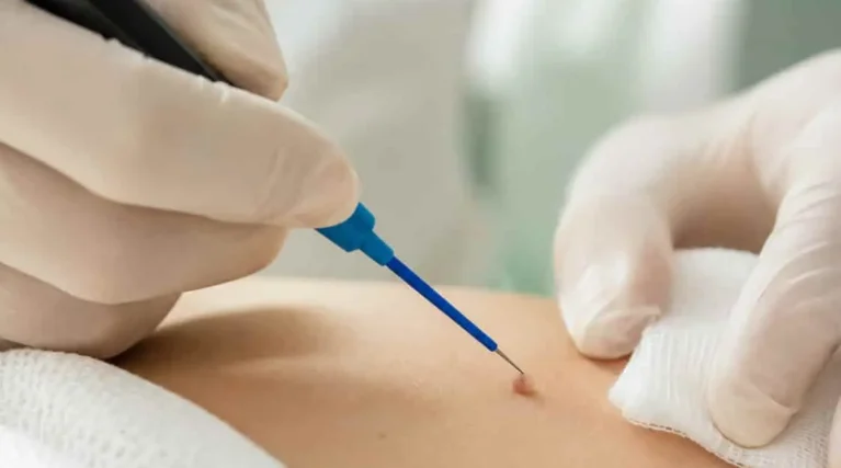HPV Tedavisinde Genital Siğilin Elektrokoter ile Tedavisi Jinekolojik onkoloji uzmanı tarafından dış genital bölgede bulunan HPV kaynaklı genital siğilin elektrokoter yöntemiyle tedavi edilmesi.