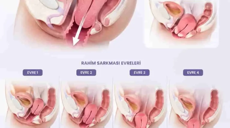 rahim sarkması neden olur rahim sarkması