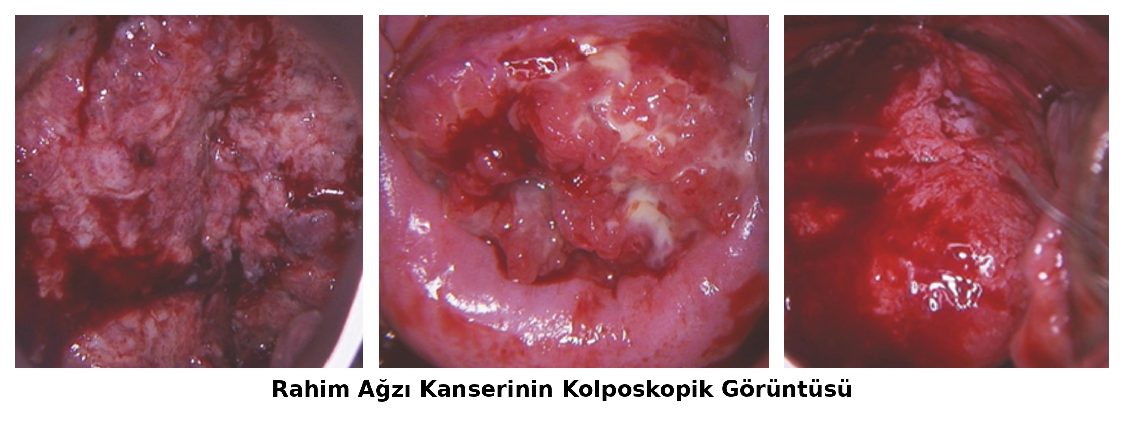 Rahim ağzı kanserine ait ülserasyon, nekroz ve düzensiz tümöral dokunun izlendiği kolposkopik görüntüler.